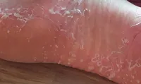 발바닥 껍질 벗겨짐